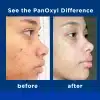 ⁦PanOxyl Acne Foaming Wash Benzoyl Peroxide 10% Max Strength - 156g | بانوكسيل غسول رغوي لحب الشباب البنزويل بيروكسايد 10% - 156 غرام⁩ - الصورة ⁦2⁩