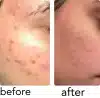 ⁦PanOxyl Acne Foaming Wash Benzoyl Peroxide 10% Max Strength - 156g | بانوكسيل غسول رغوي لحب الشباب البنزويل بيروكسايد 10% - 156 غرام⁩ - الصورة ⁦3⁩